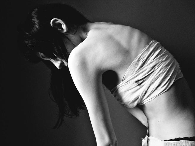 anorexia5.